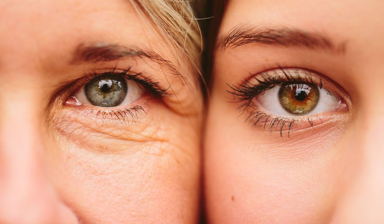 σημάδια γήρανσης γύρω από τα μάτια
