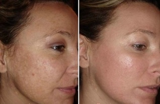 αναζωογόνηση του δέρματος του προσώπου με λέιζερ πριν και μετά τις φωτογραφίες